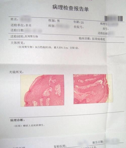 尖锐湿疣单方治疗，轻松告别烦恼！