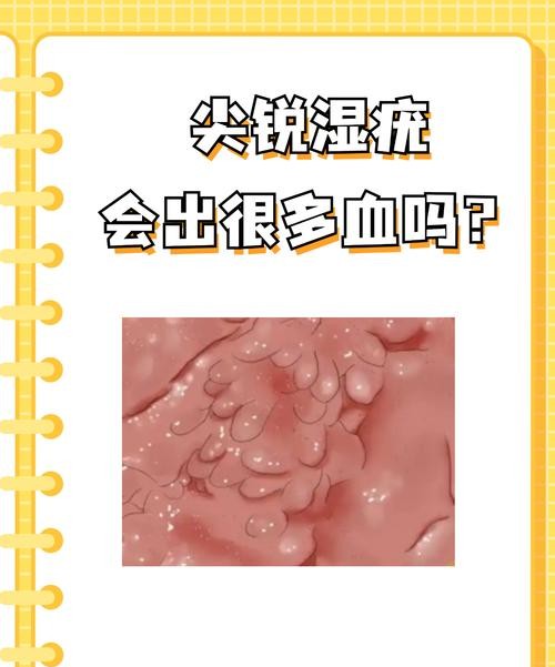 尖锐湿疣在血液吗？医生揭秘病毒传播真相
