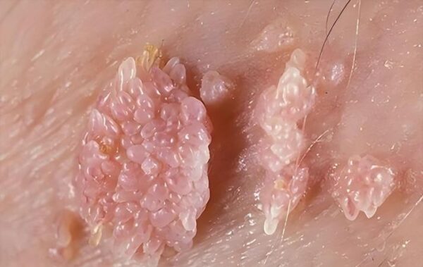 尖锐湿疣女的图片曝光！这些症状你中招了吗？