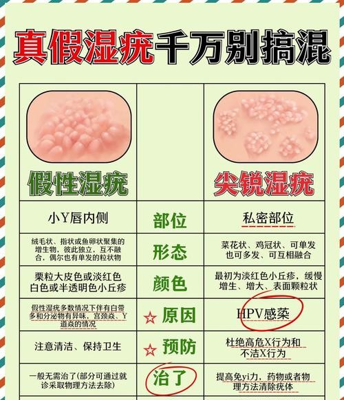 尖锐湿疣如何判断？这5个症状一查便知！