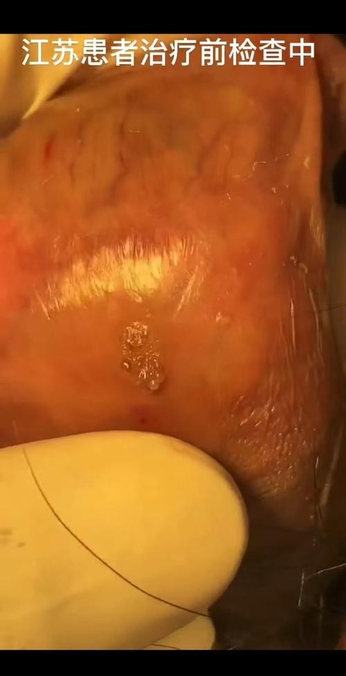 徐州尖锐湿疣患者必看：这些治疗方法让你少走弯路