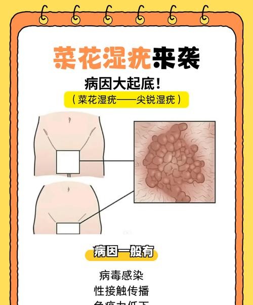 尖锐湿疣是中国的“隐形杀手”？这些真相你必须知道！