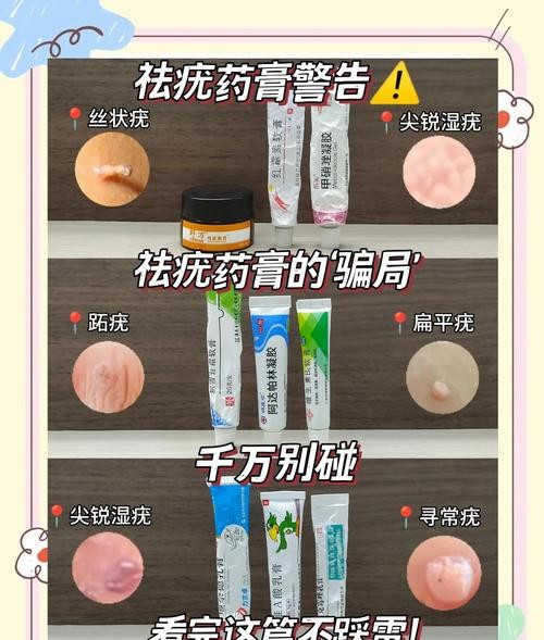 尖锐湿疣治不好？这些方法让你彻底告别困扰！