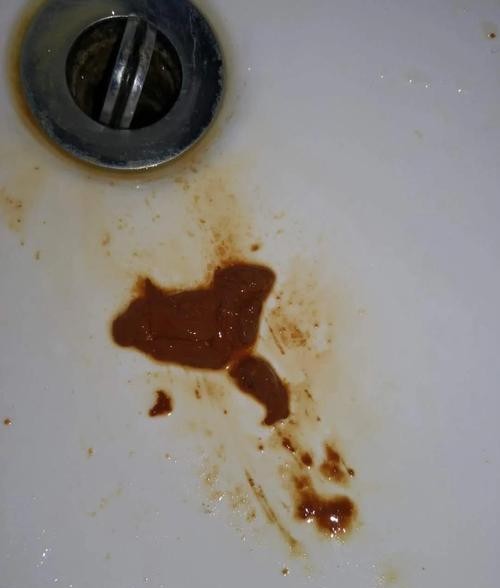 拉肚子拉血水别忽视！可能是这些疾病在作祟