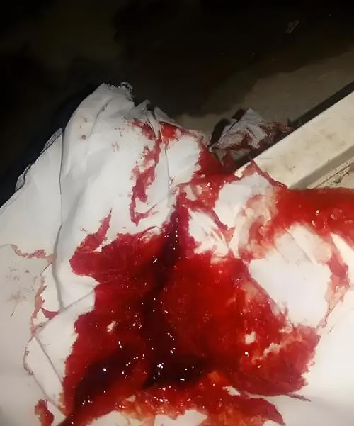 拉肚子拉血水别忽视！可能是这些疾病在作祟