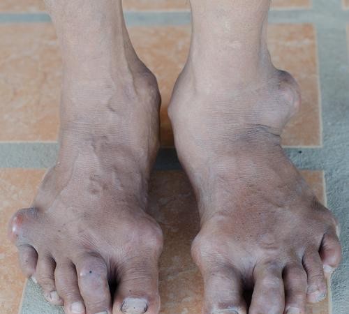 痛风初犯别大意！这5个信号提醒你该注意了