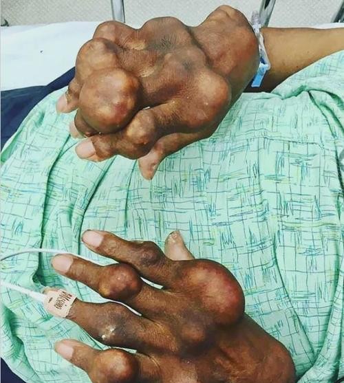 痛风性关节炎并发症：别让这些隐患毁了你的健康！