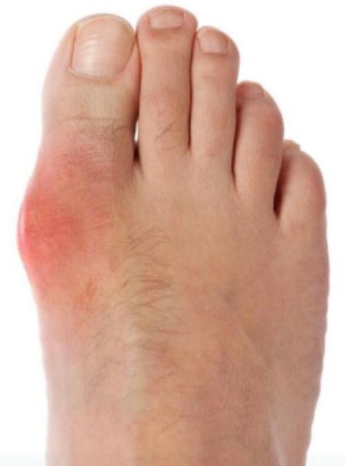 痛风烫脚，缓解疼痛还是加重病情？真相让人意外！