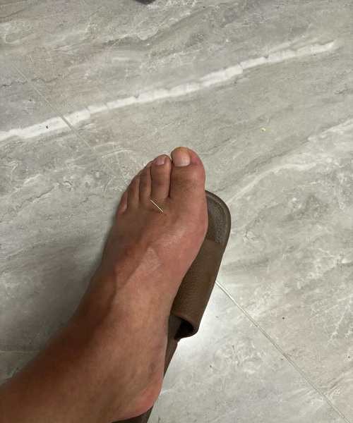 痛风烫脚，缓解疼痛还是加重病情？真相让人意外！