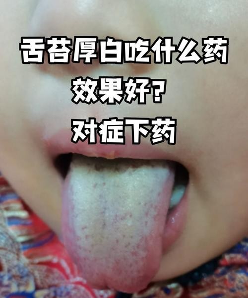 舌头发白吃什么药好？这5种药物最有效！