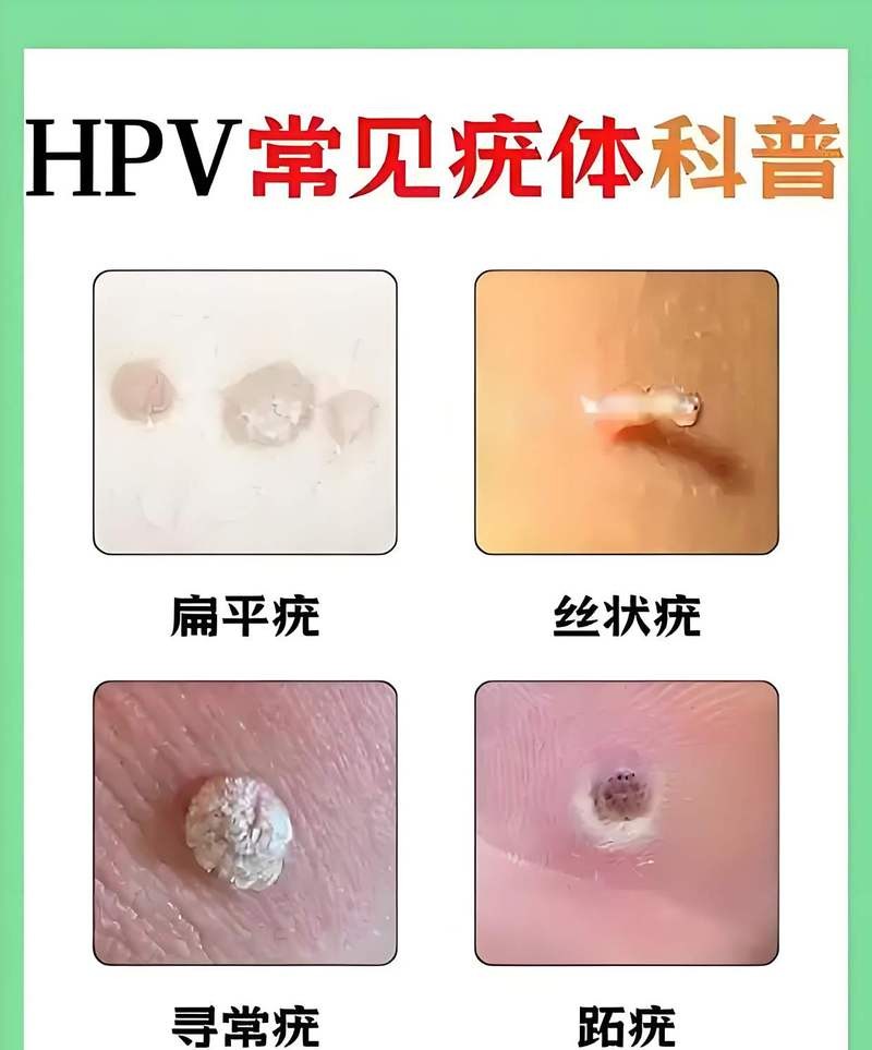 西安治疗尖锐湿疣，这几家医院效果最好！