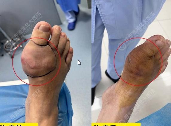 西安痛风患者必看！这些方法让你告别疼痛折磨