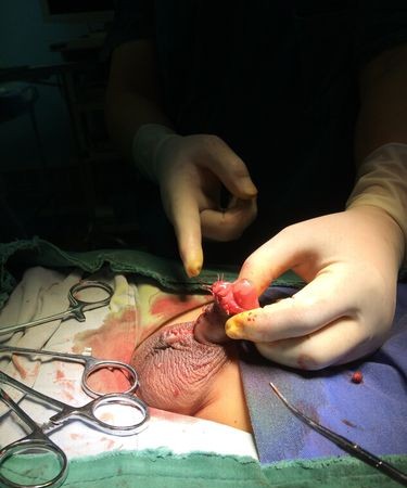 重庆医学院治疗包皮过长，专业安全无痛解决男性困扰